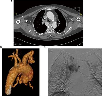 Case Report: Combined transcatheter arterial embolization and aortic stent-graft have better efficacy for bronchial artery aneurysms